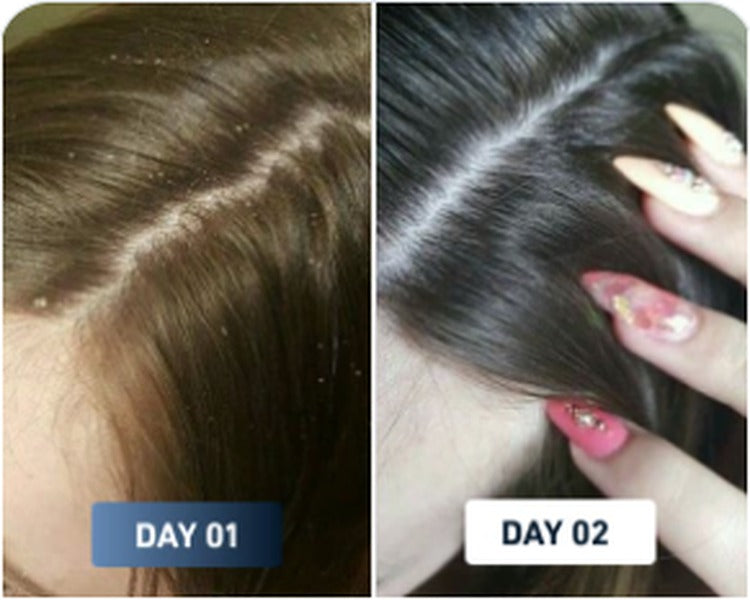 Flaky scalp before and after result 1