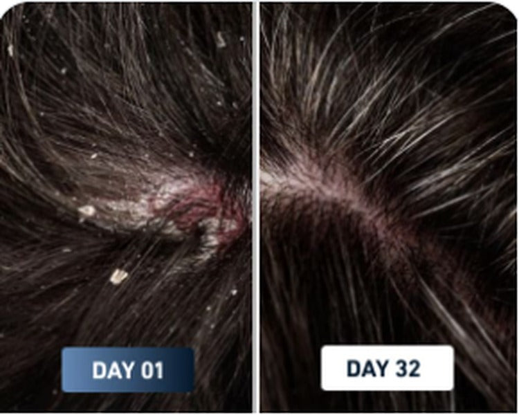 Flaky scalp before and after result 2