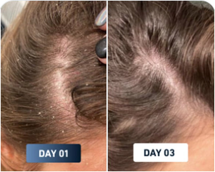 Flaky scalp before and after result 3