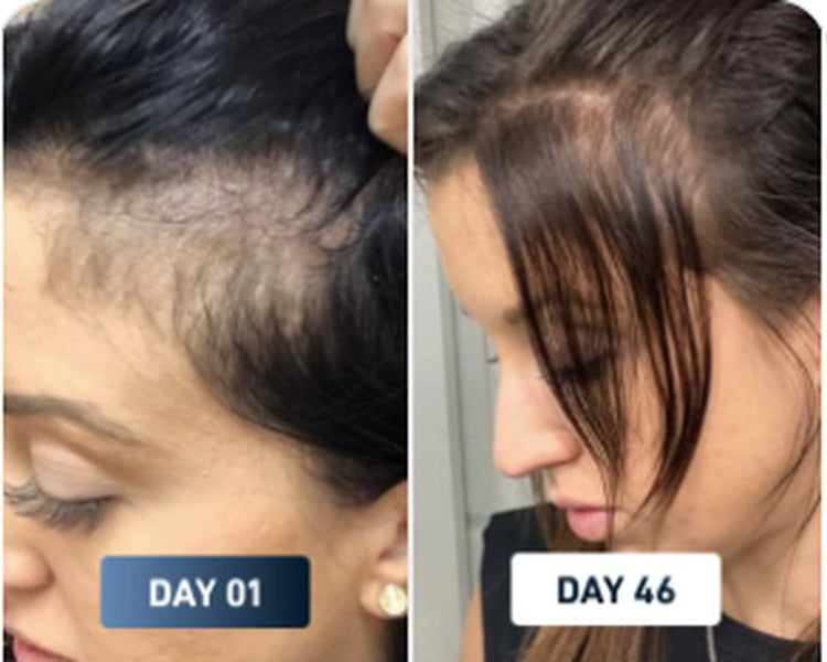 Hair shedding before and after result 2
