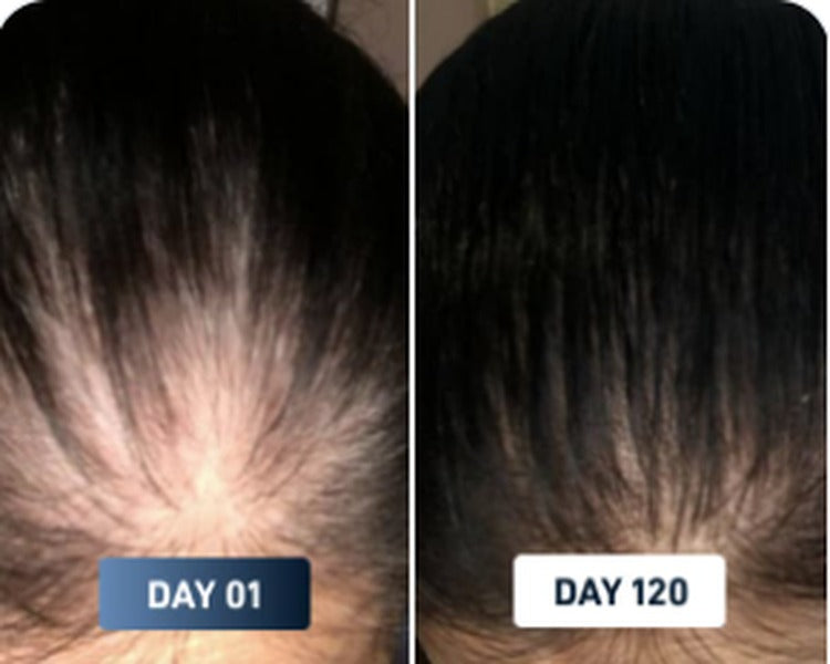 Hair shedding before and after result 3